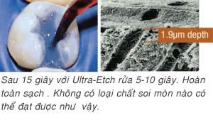 59-12-UltraEtch-ULTRADENT