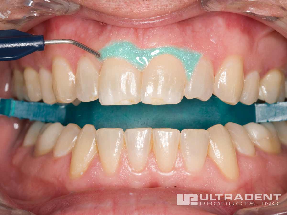 Opalescence-Boost-Procedure_Step-4