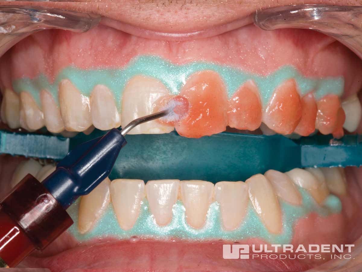 Opalescence-Boost-Procedure_Step-6