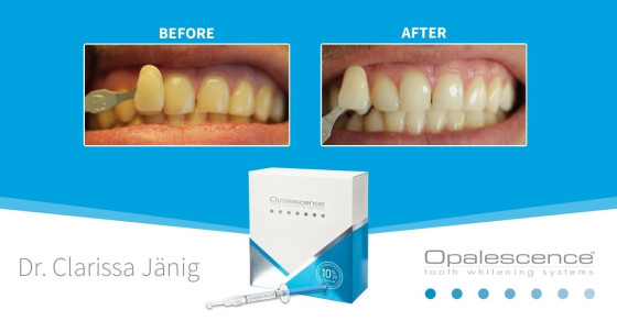 ultradent tẩy trắng răng opalesence