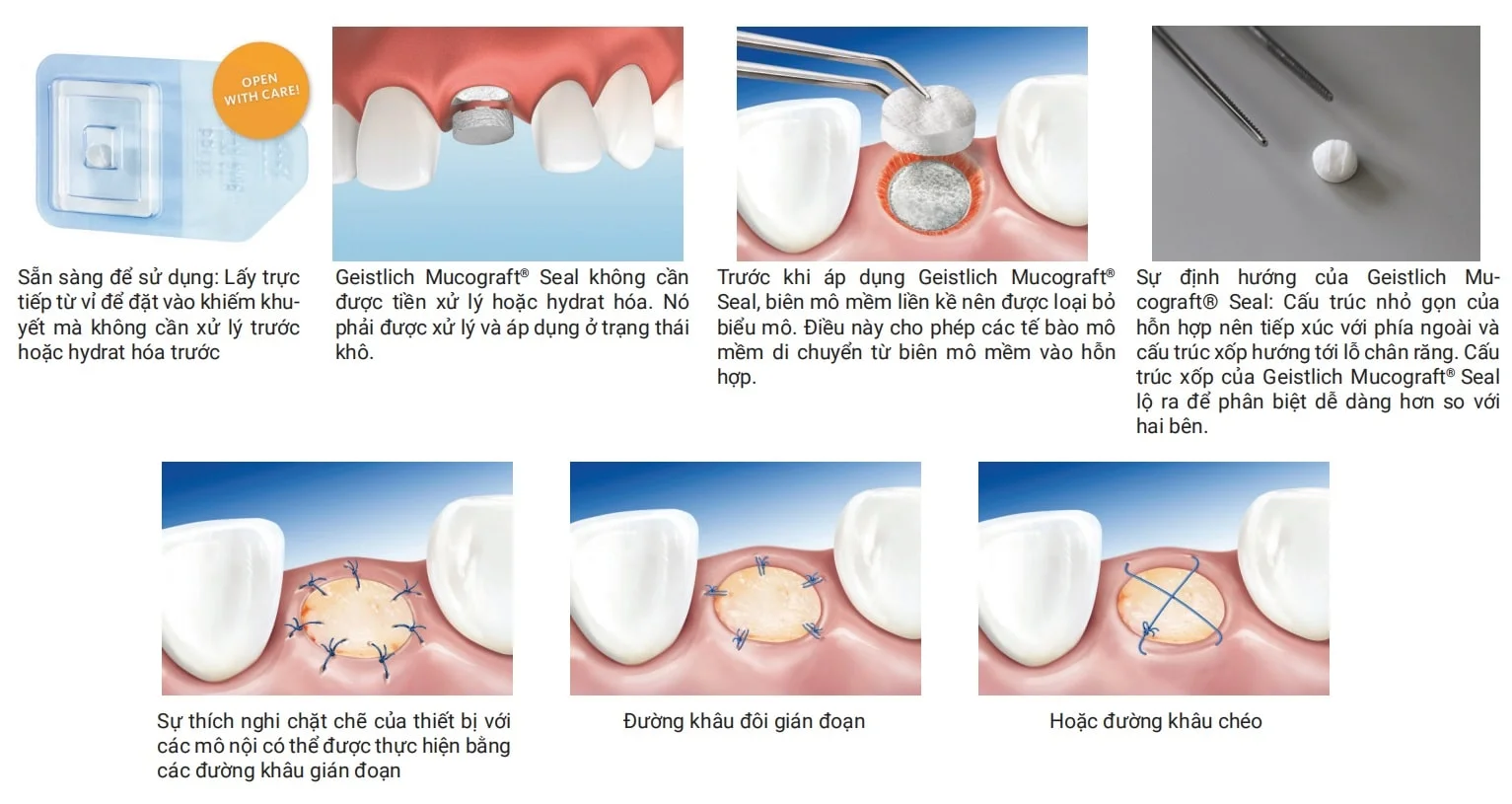 hướng dẫn sử dụng geistlich mucograft seal
