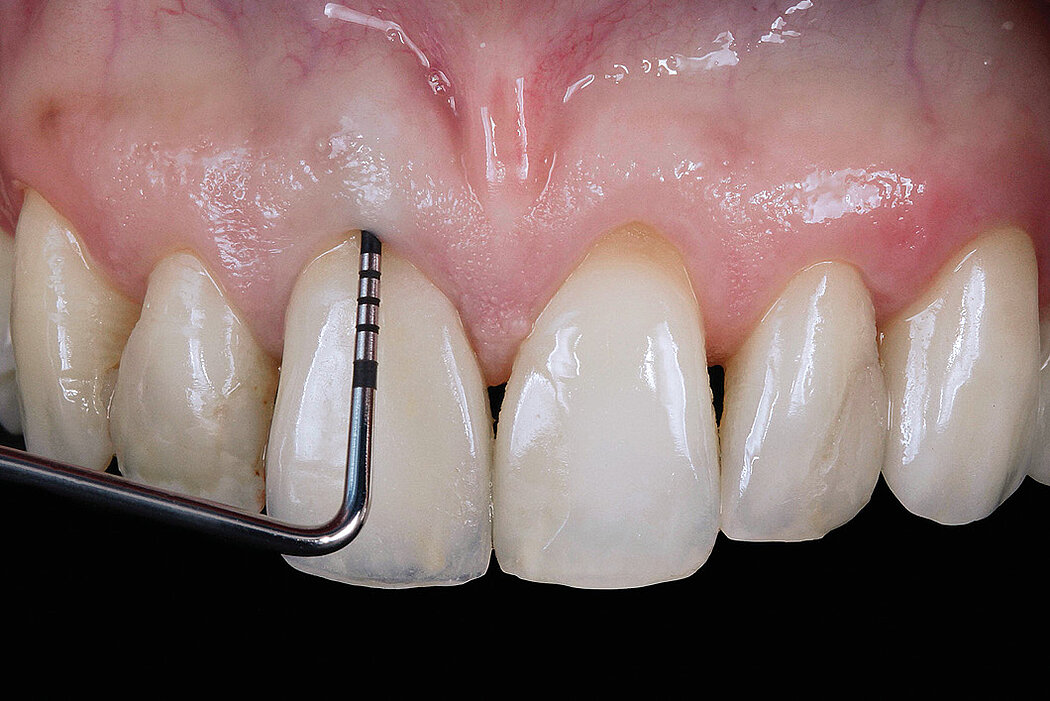 Thăm khám ban đầu cho thấy độ sâu thăm dò là 9,0 mm, phát hiện một chân răng nứt, gãy. Chụp CBCT xác định có sự tiêu xương sóng hàm.