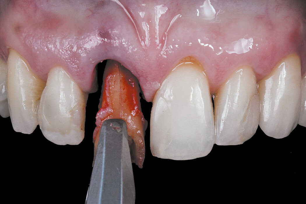 Nhổ răng cẩn thận và nhẹ nhàng theo phương pháp xâm lấn tối thiểu để không làm tổn thương thêm ổ răng.