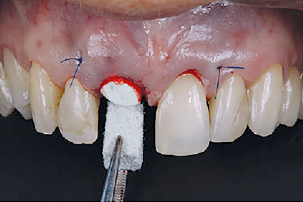 Geistlich Bio-Oss Collagen được đặt vào để lấp đầy khoảng trống giữa implant và thành xương ổ răng. Màng phải vượt quá đỉnh và mặt bên của khuyết hỏng ít nhất 3mm.