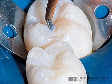 câu chuyện về ultraseal xt plus của bác sĩ shea bess 2 inspiral brush tip của ultradent đảm bảo việc áp dụng sealant đều và mịn