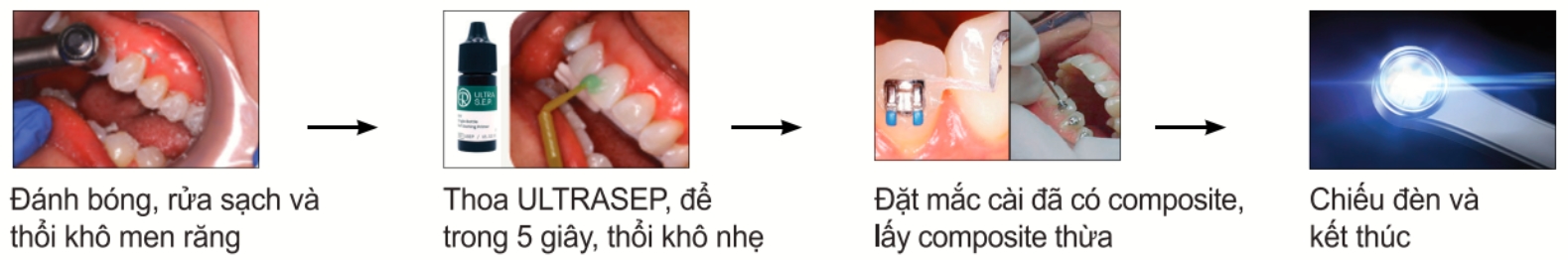 chất dán chỉnh nha tự soi mòn ultra sep 2 chat dan chinh nha tu soi mon ultra sep