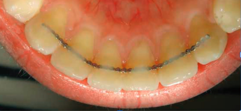 composite long microfil quang trung hop flow tain 1