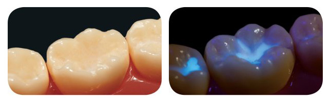 ultraseal xt hydro: giải pháp trám bít hố rãnh ưu việt với kỹ thuật liên kết ưa nước 3 đặc tính huỳnh quang của ultraseal xt hydro giúp nó được nhìn thấy toàn bộ dưới ánh sáng cực tím