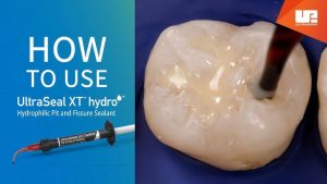 Cách đặt Sealant đúng cách với UltraSeal XT hydro