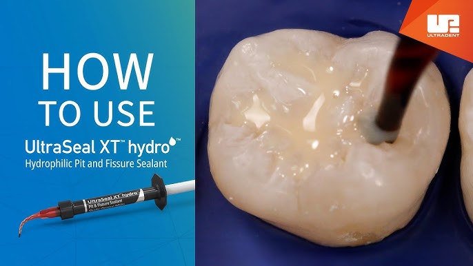 trang chủ 89 cách đặt sealant đúng cách với ultraseal xt hydro