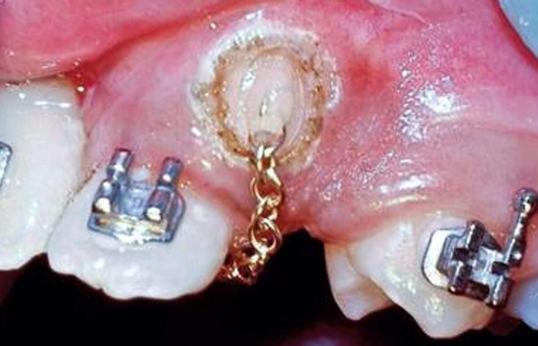 oval composite & chain system - khuôn tạo nút composite và dây chuỗi kéo răng ngầm 2 oval composite chain system khuon tao nut composite va day chuoi keo rang ngam 1