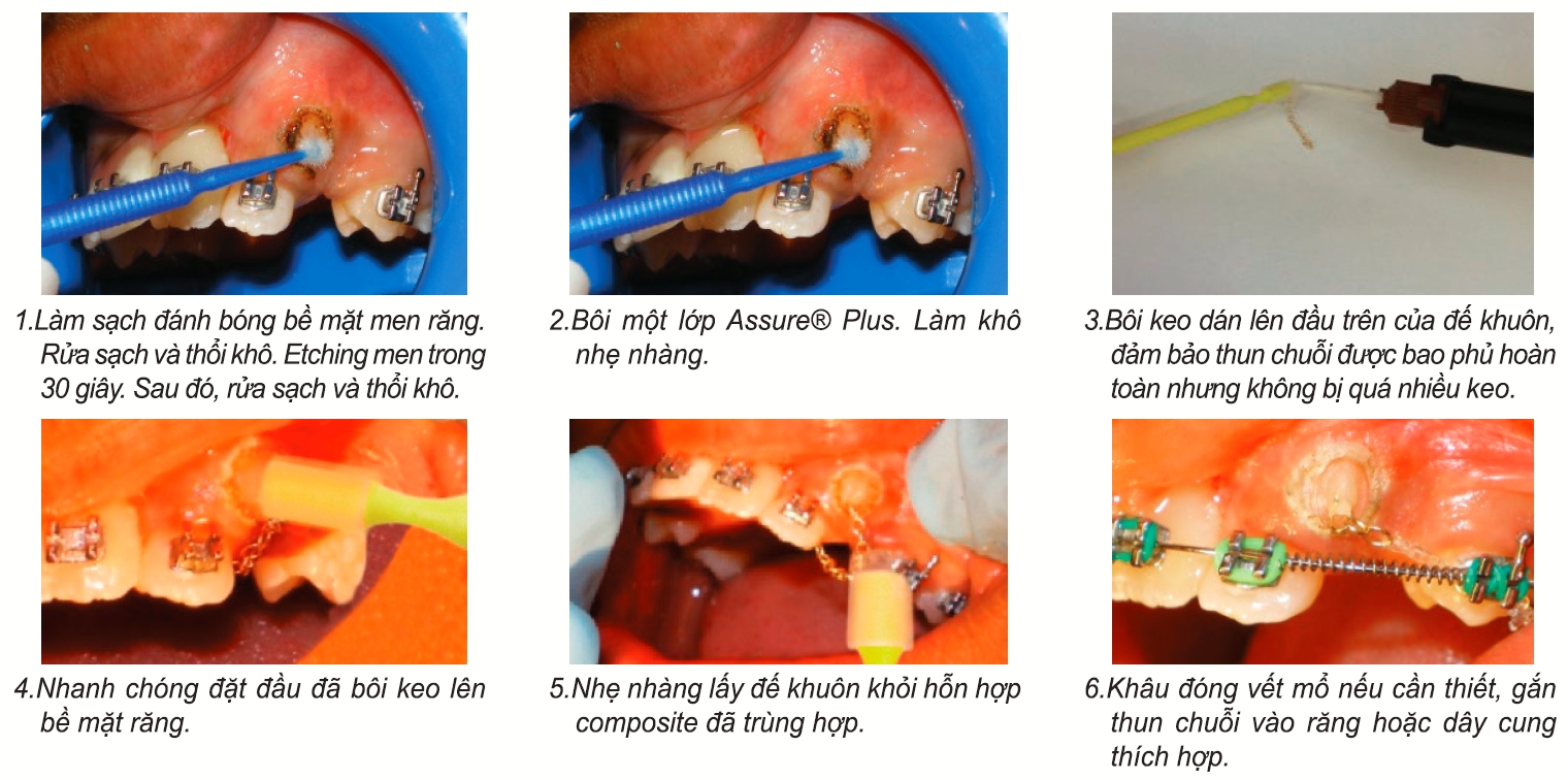 oval composite & chain system - khuôn tạo nút composite và dây chuỗi kéo răng ngầm 3 hướng dẫn sử dụng oval composite & chain system - khuôn tạo nút composite và dây chuỗi kéo răng ngầm