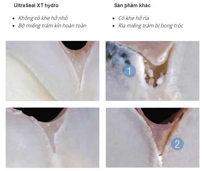 ultraseal xt hydro: giải pháp trám bít hố rãnh ưu việt với kỹ thuật liên kết ưa nước 2 so sánh hiệu quả lâm sàng ultraseal xt hydro và các chất trám bít thông thường