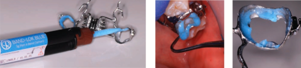 band lok dual cure 2 xi mang gan khau dang ong tron bandlok dual cure 1