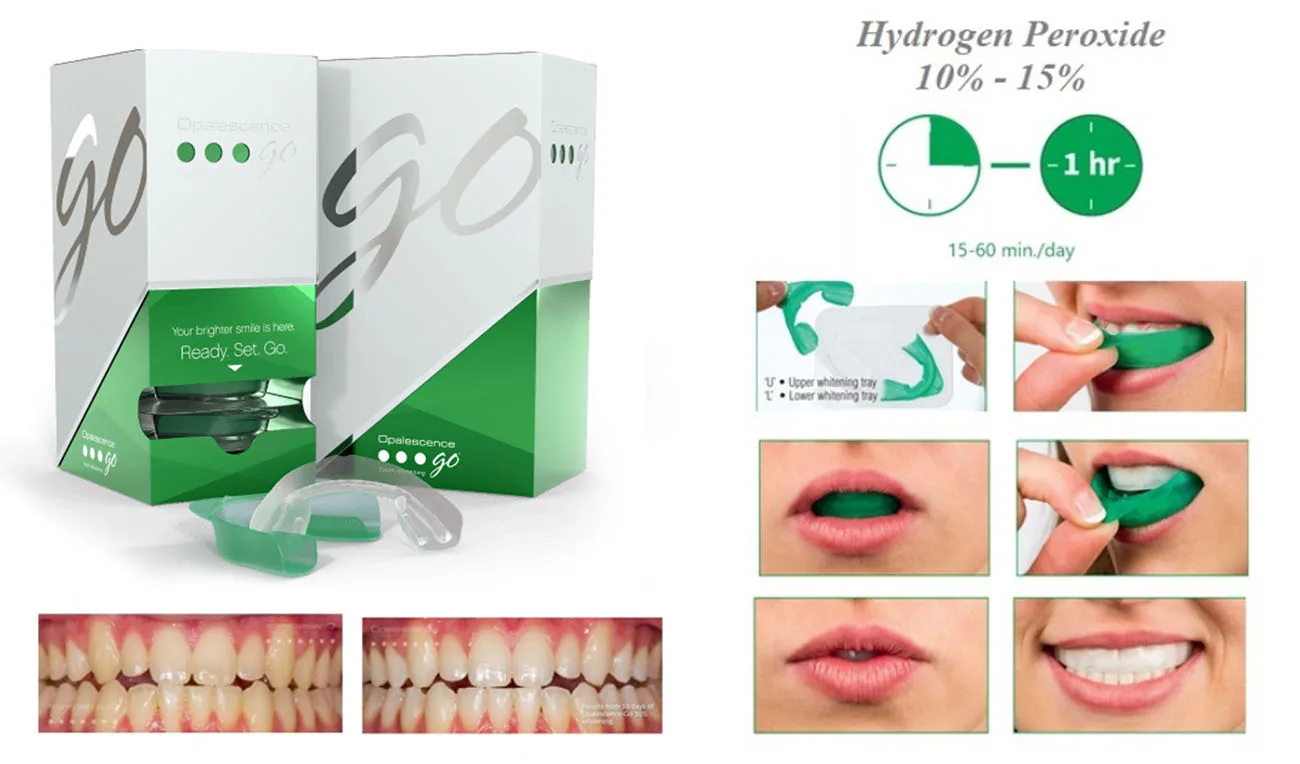 top 5 cách tẩy trắng răng tại nhà hiệu quả và an toàn nhất 2 opalescence go - sản phẩm tẩy trắng tại nhà tiện lợi nhất