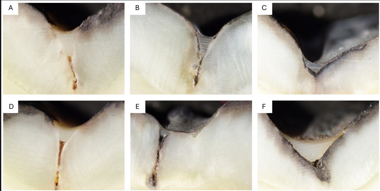 so sanh ultraseal xt hydro va clinpro 3m sealant nao tot hon 3
