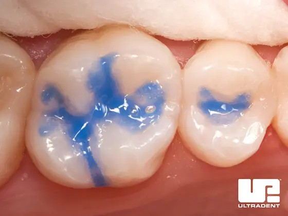 vì sao nên chọn ultra-etch ultradent