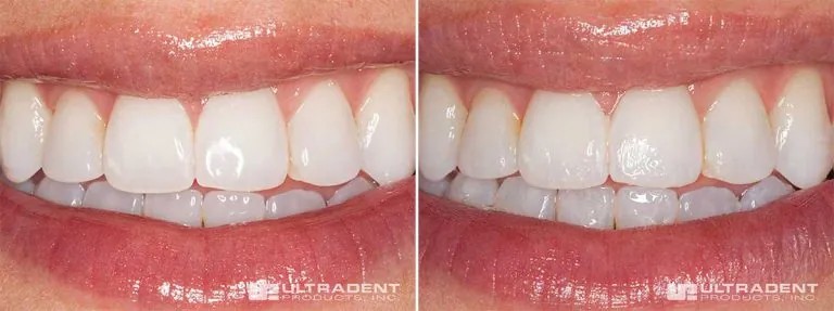 ưu điểm vượt trội của enamelast