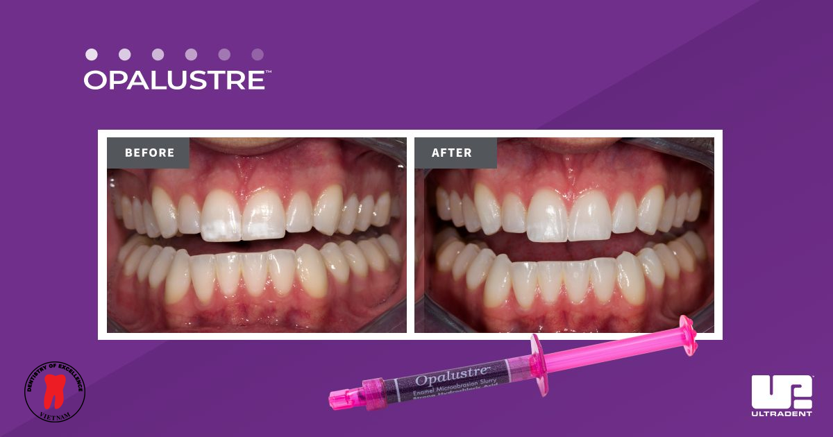 điều trị đốm trắng - dr. renato miotto palo, dds 2 điều trị đốm trắng opalustre