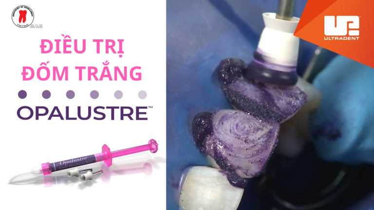 điều trị đốm trắng - dr. renato miotto palo, dds