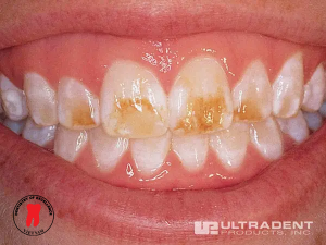 điều trị đốm trắng - dr. renato miotto palo, dds 4 bước 1: quy trình điều trị đốm trắng bằng opalustre