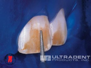 điều trị đốm trắng - dr. renato miotto palo, dds 5 bước 2: quy trình điều trị đốm trắng bằng opalustre