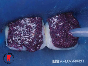 điều trị đốm trắng - dr. renato miotto palo, dds 6 bước 3: quy trình điều trị đốm trắng bằng opalustre