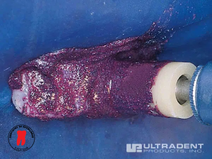 điều trị đốm trắng - dr. renato miotto palo, dds 7 bước 4: quy trình điều trị đốm trắng bằng opalustre