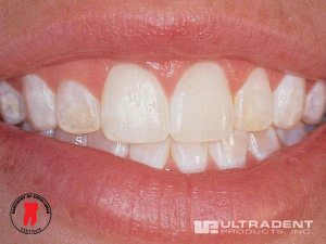 điều trị đốm trắng - dr. renato miotto palo, dds 8 bước 5: quy trình điều trị đốm trắng bằng opalustre