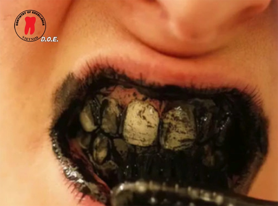 tẩy trắng răng trong nha khoa có gây hại không? 4 tẩy trắng răng tự chế như dùng than hoạt tính