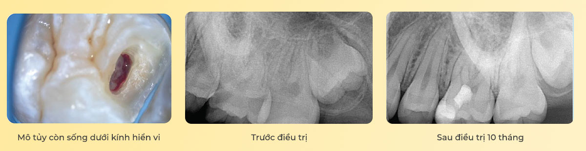 noi nha chuyen sau module 1.1