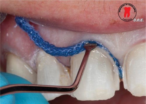 chỉ co nướu ultrapak – giải pháp kiểm soát mô mềm hiệu quả trong phục hình nha khoa