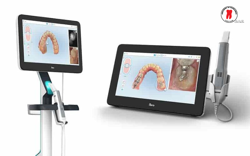 quy trình niềng khay trong suốt