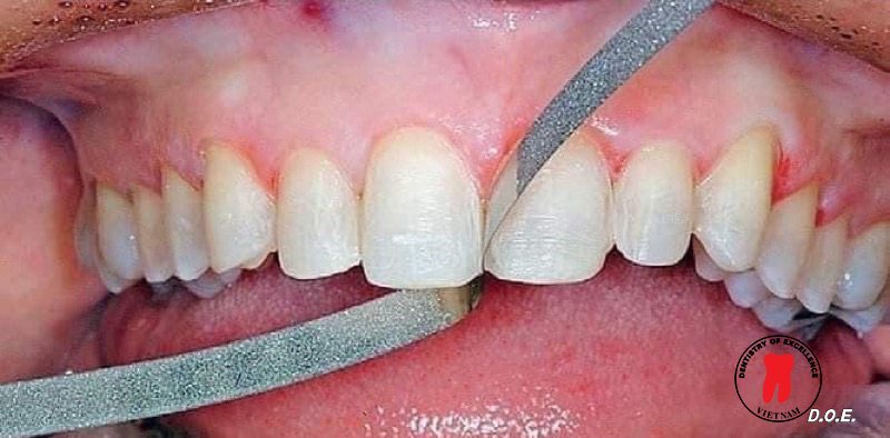 tại sao cần thực hiện mài kẽ răng?
