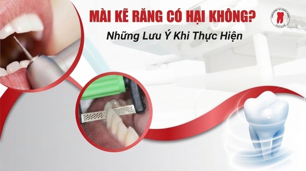 mài kẽ răng có hại không? những lưu ý khi thực hiện