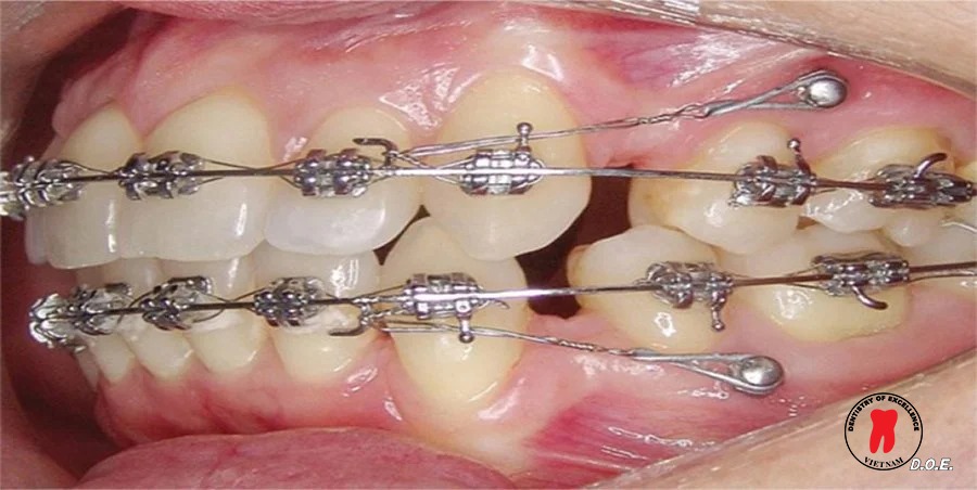 minivis dentos– giải pháp neo chặn hiệu quả trong chỉnh nha hiện đại 1 minivis chỉnh nha