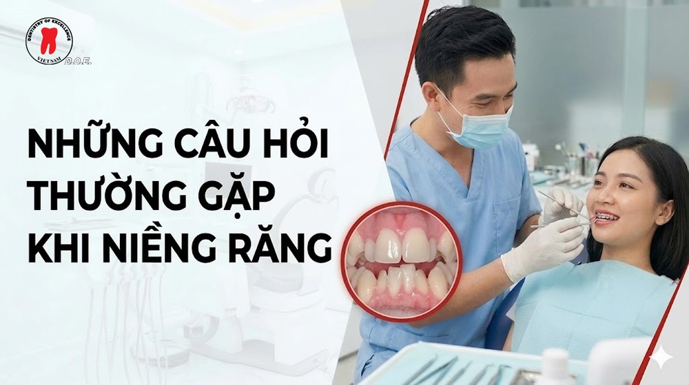 những câu hỏi thường gặp khi niềng răng