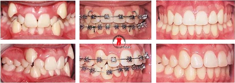 những câu hỏi thường gặp khi niềng răng 1
