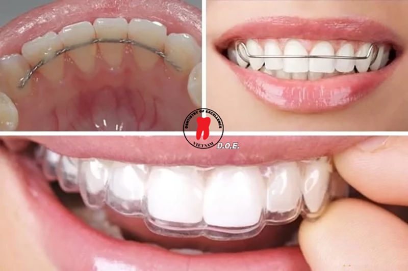 những câu hỏi thường gặp khi niềng răng 4