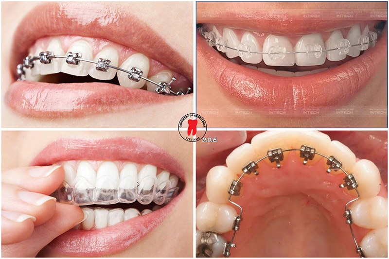 những câu hỏi thường gặp khi niềng răng 2