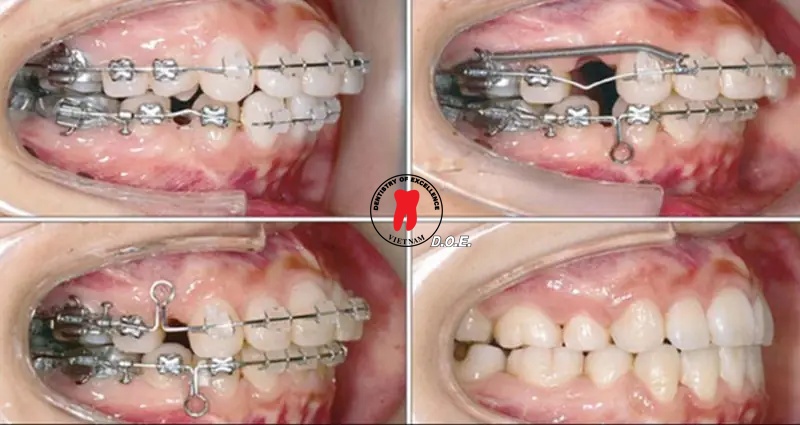 những câu hỏi thường gặp khi niềng răng 3