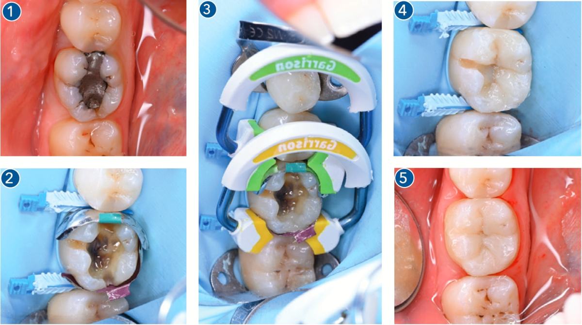 strata g sectional matrix system professional kit bo khuon tram xoang ii 1