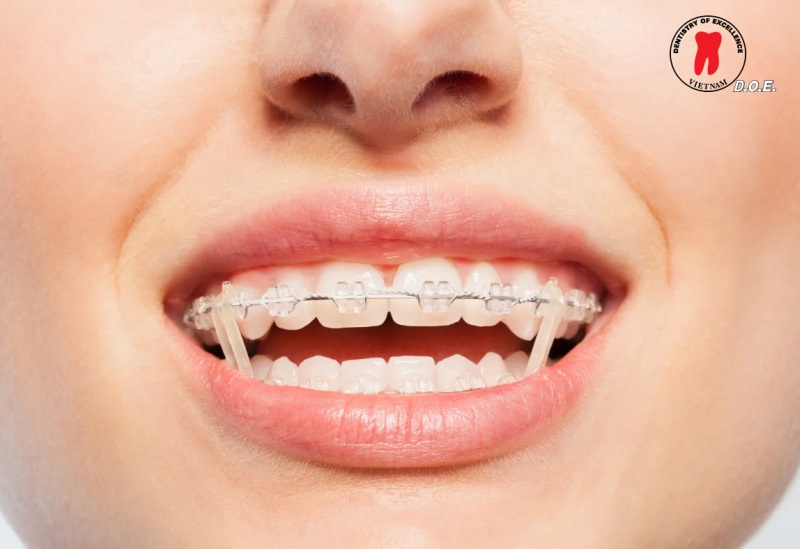 vai trò của thun liên hàm trong điều trị chỉnh nha 