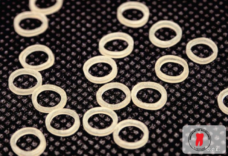 thun liên hàm trong chỉnh nha là gì?