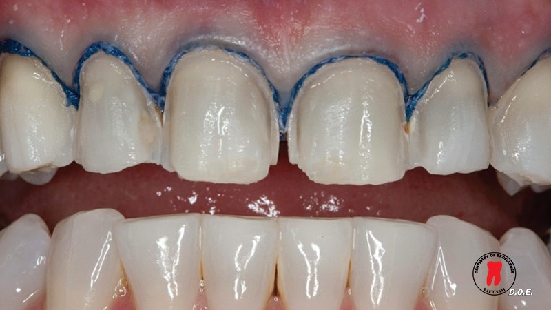 chi co nuou ultrapak cord ultradent 1