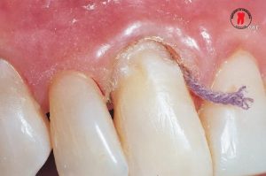 chi co nuou ultrapak cord ultradent 3