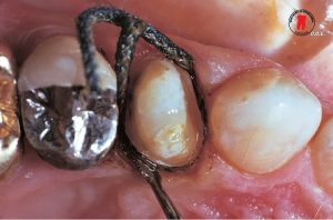 chi co nuou ultrapak cord ultradent 6