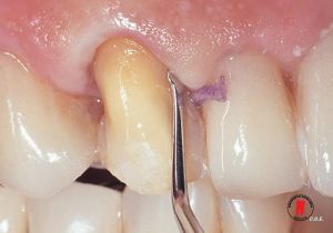 chi co nuou ultrapak cord ultradent 7