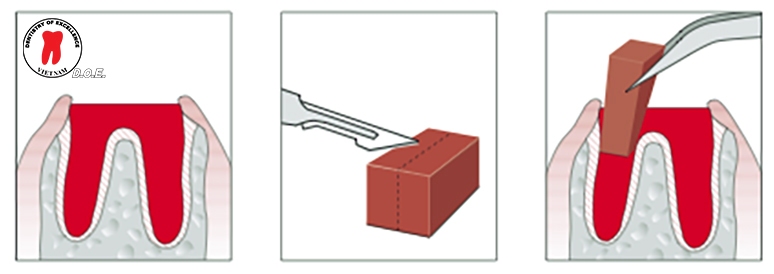 gelatamp roeko giai phap vang kiem soat cam mau 5