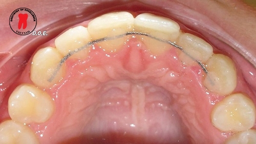 hàm duy trì sau chỉnh nha: phân loại, thời gian đeo và cách vệ sinh. 3 ham duy tri sau chinh nha phan loai thoi gian deo va cach ve sinh 2